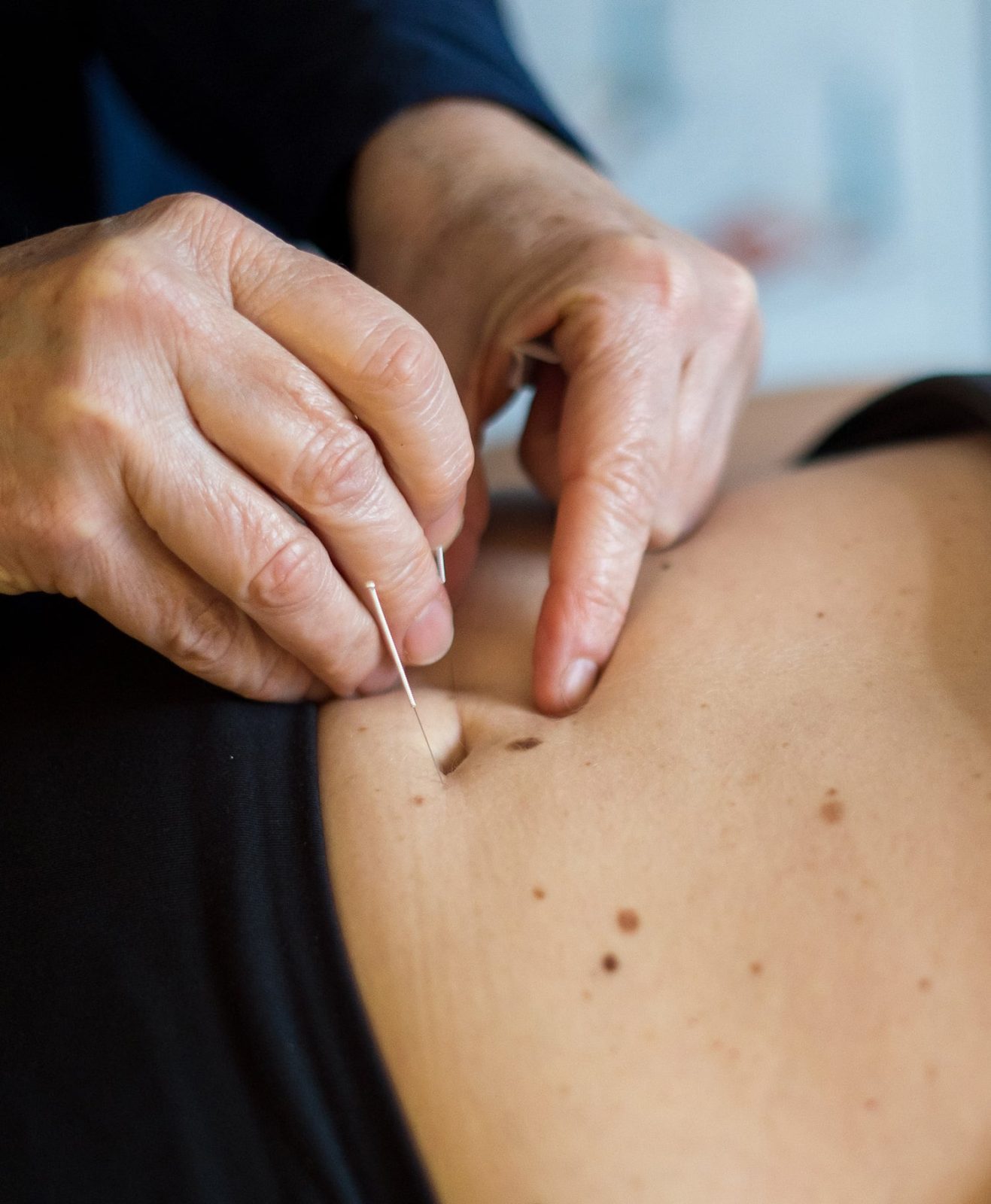 Akupunkturbehandling på maven